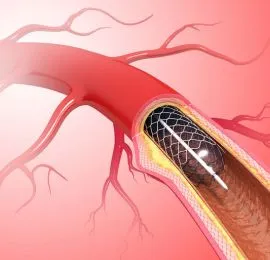 Angioplasty
