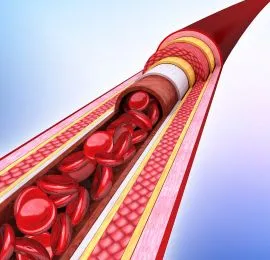 Post CABG Angioplasty