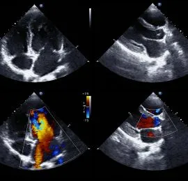 Stress/Contrast Echo